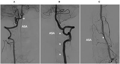 Role of the Cervical Anterior Spinal Artery in the Endovascular Treatment of Vascular Diseases: Bystander, Accomplice, Victim, or Friend?